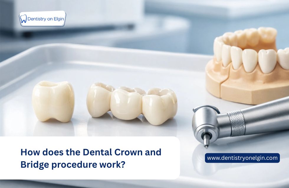 How Does the Dental Crown and Bridge Procedure Work?